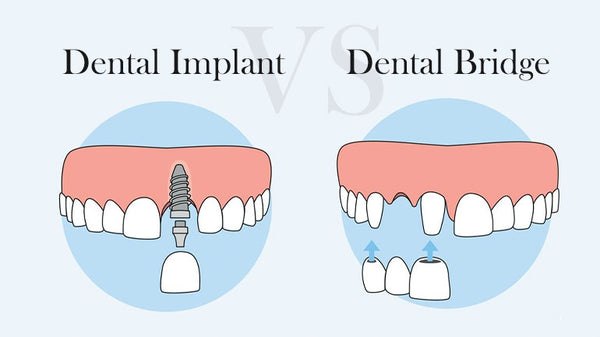 Dental Implant Vs Dental Bridge – Which One Is Right for You - GREAT ...